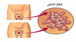 تبخال تناسلی