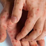 آبله میمونی Mpox